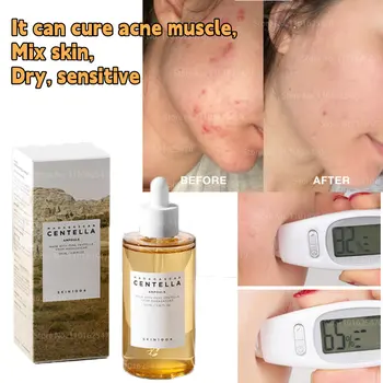 Skin1004 Centella Asiatica Essência Solução de Hidratação e Reparação de Músculos Sensíveis Tratar a Acne Mulheres e Aliviar a Secura 100ml
